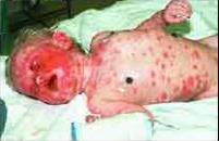 infant with Stevens-Johnson Syndrome, a blistering, peeling, potentially fatal skin rash. It is one of the known side-effects of the AIDS drug Nevirapine. Nevirapine is one of the primary drugs being readied for distribution in Africa.